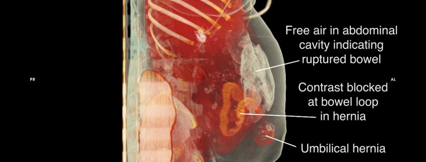 Medmovie Strangulated Umbilical Hernia