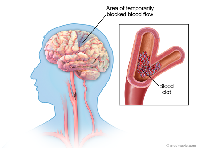 What is a Transient Ischemic Attack (TIA)?