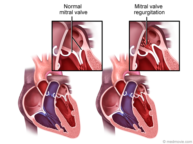 stenosis-mitral-valve-stenosis