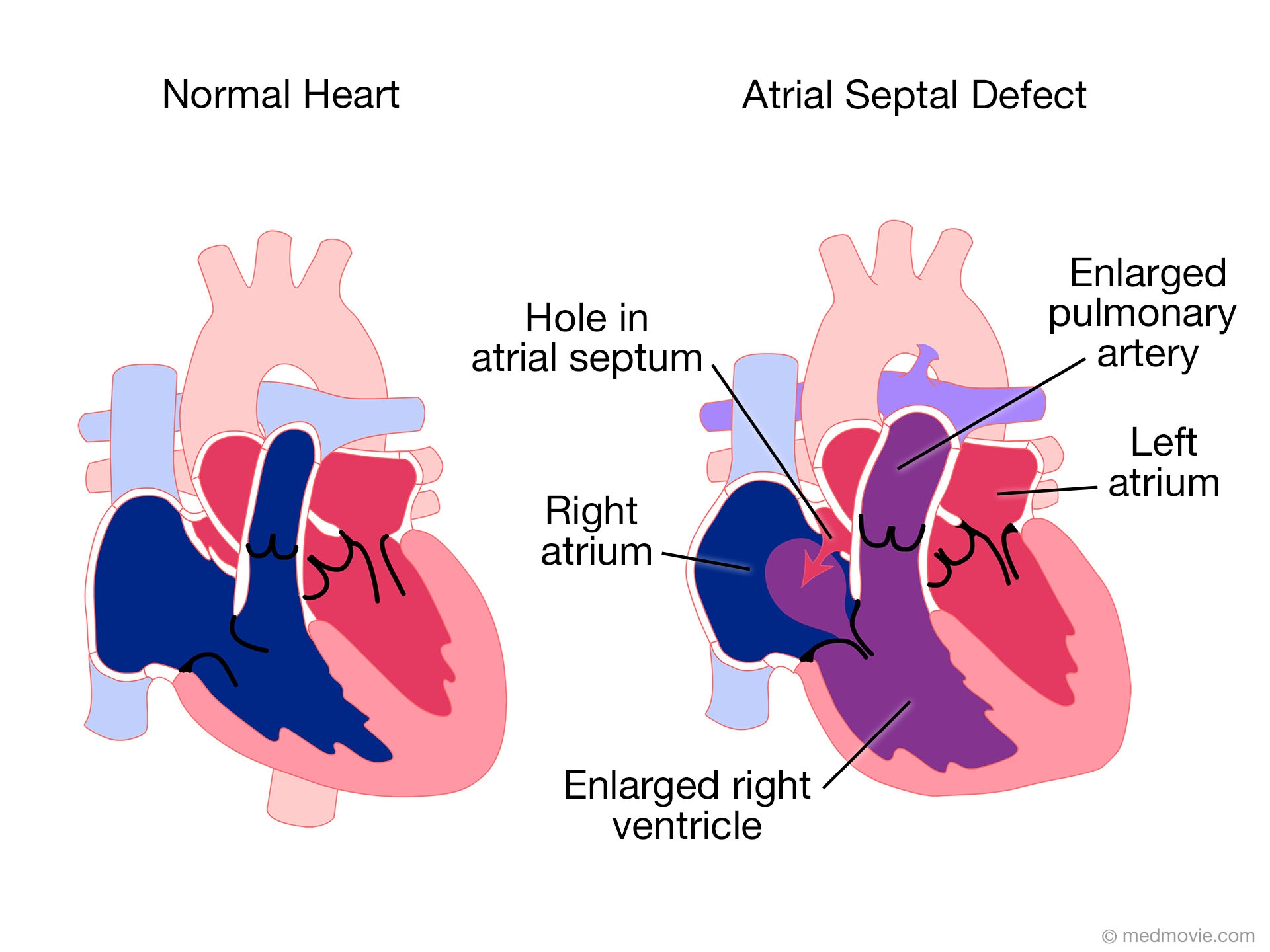 What is an atrial septal aneurysm?