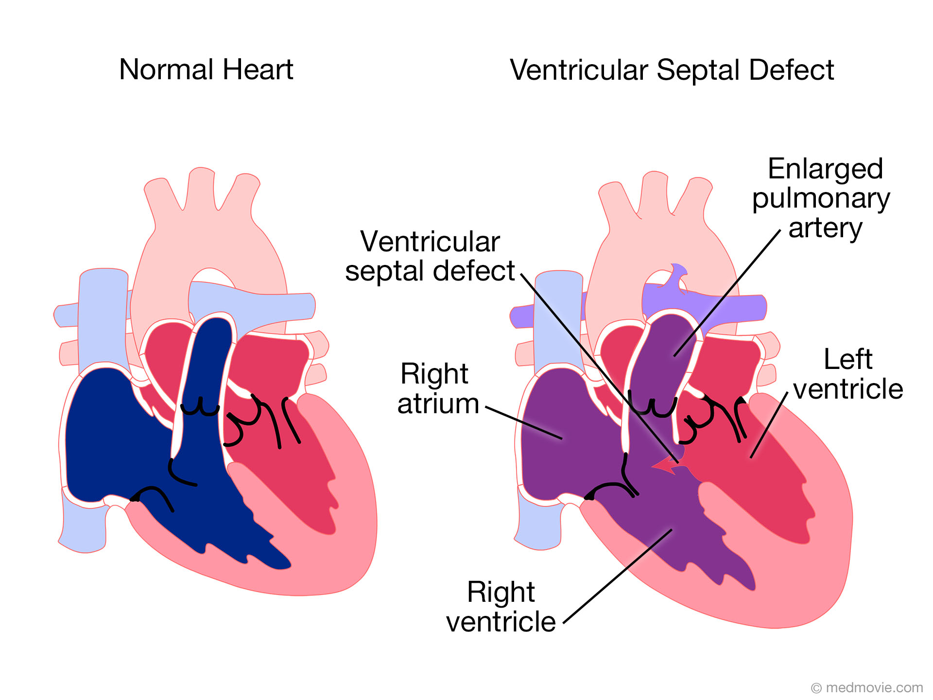 Ventricular Septal Defect