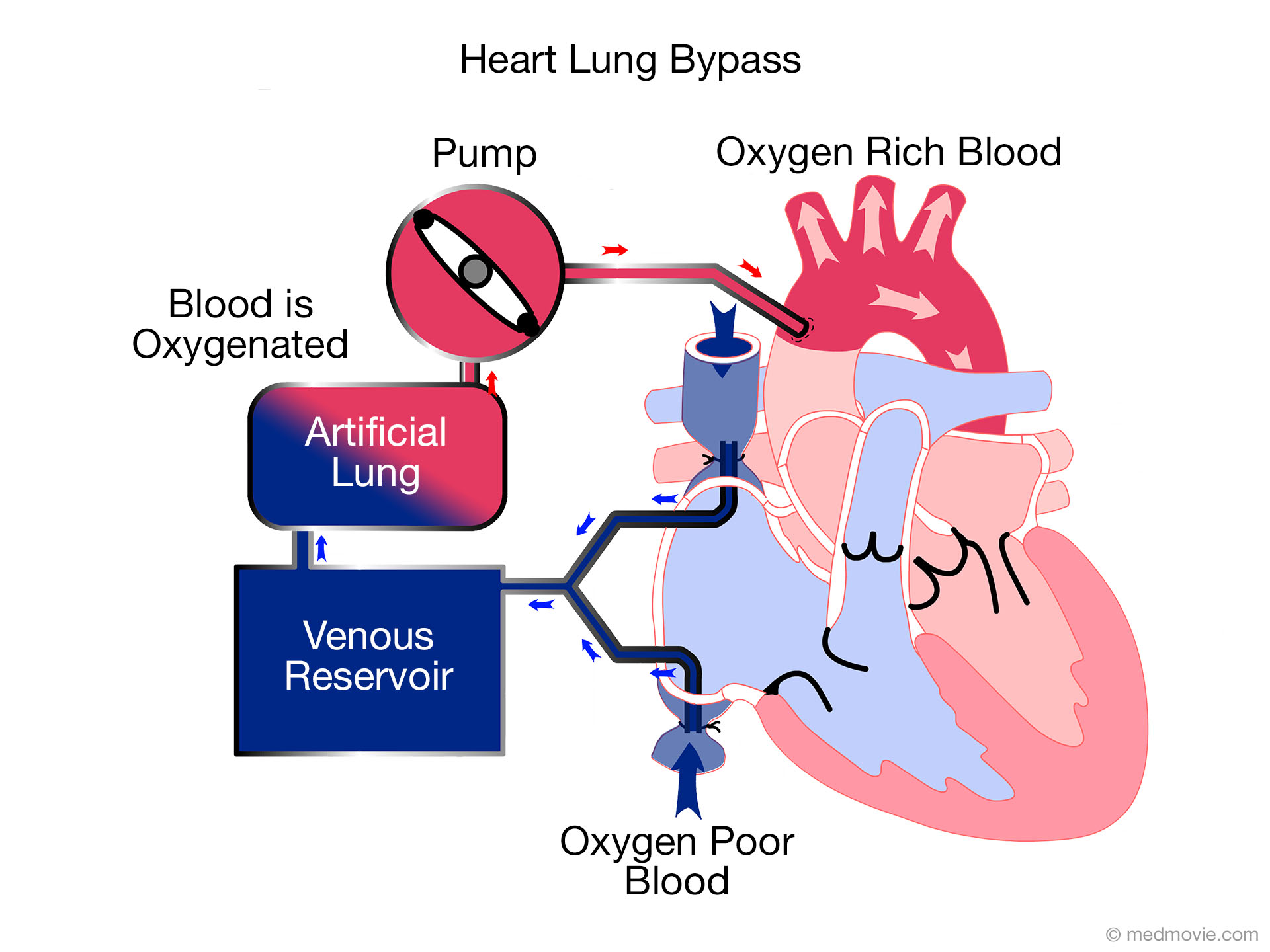 Cardiopulmonary Bypass  Heart