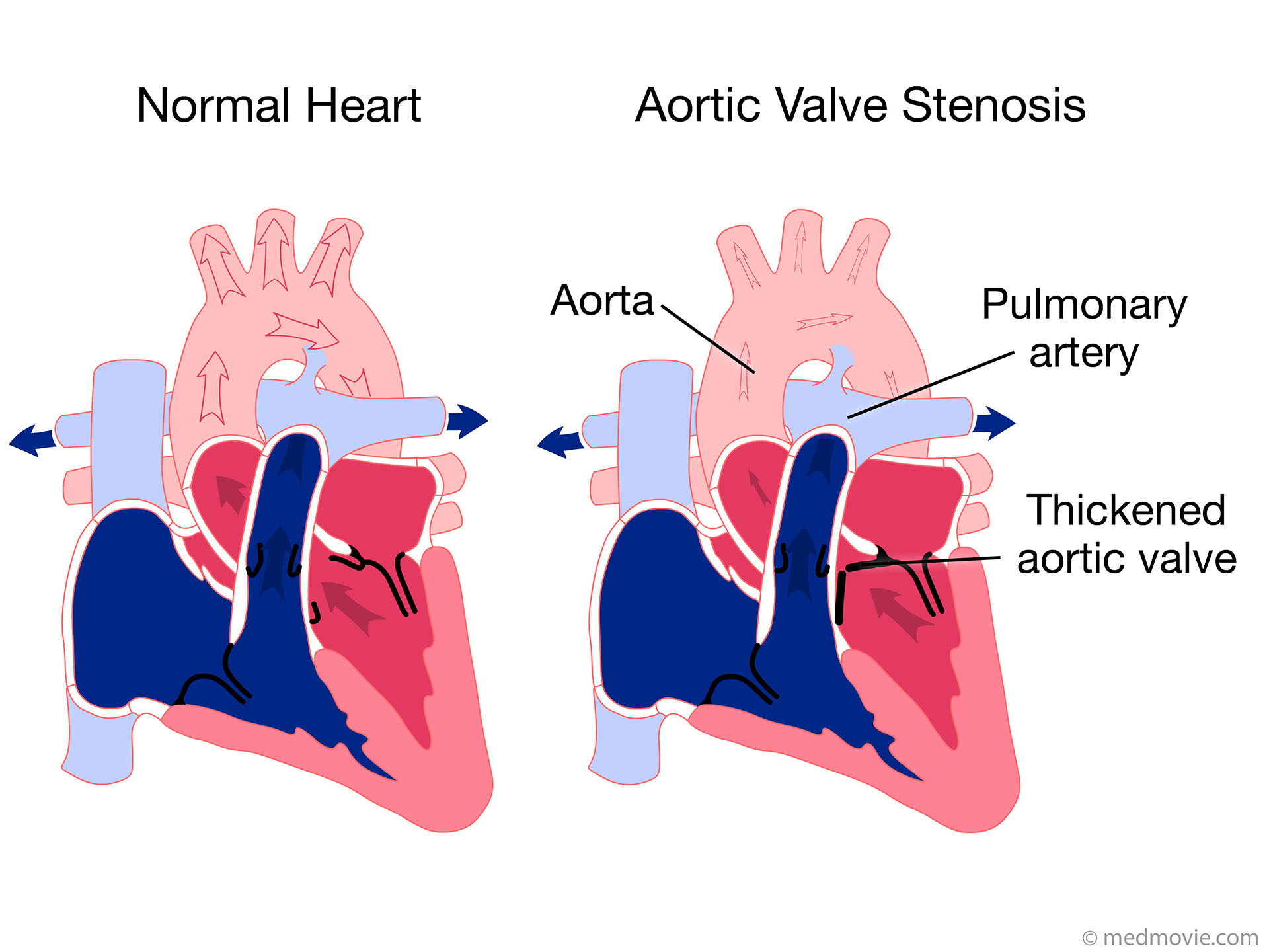 Pulmonary Valve Stenosis