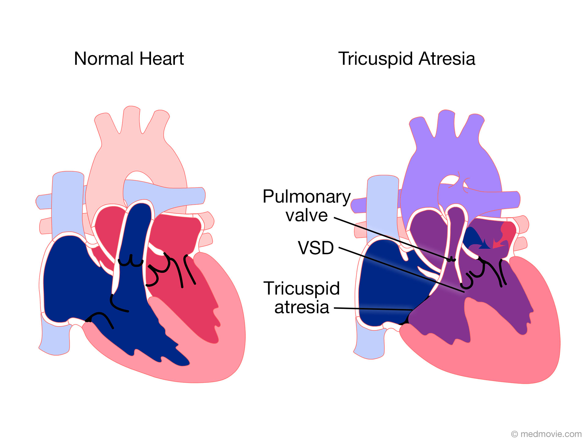 tricuspid-atresia-atresia-tricuspid-tricuspid-valve-atresia