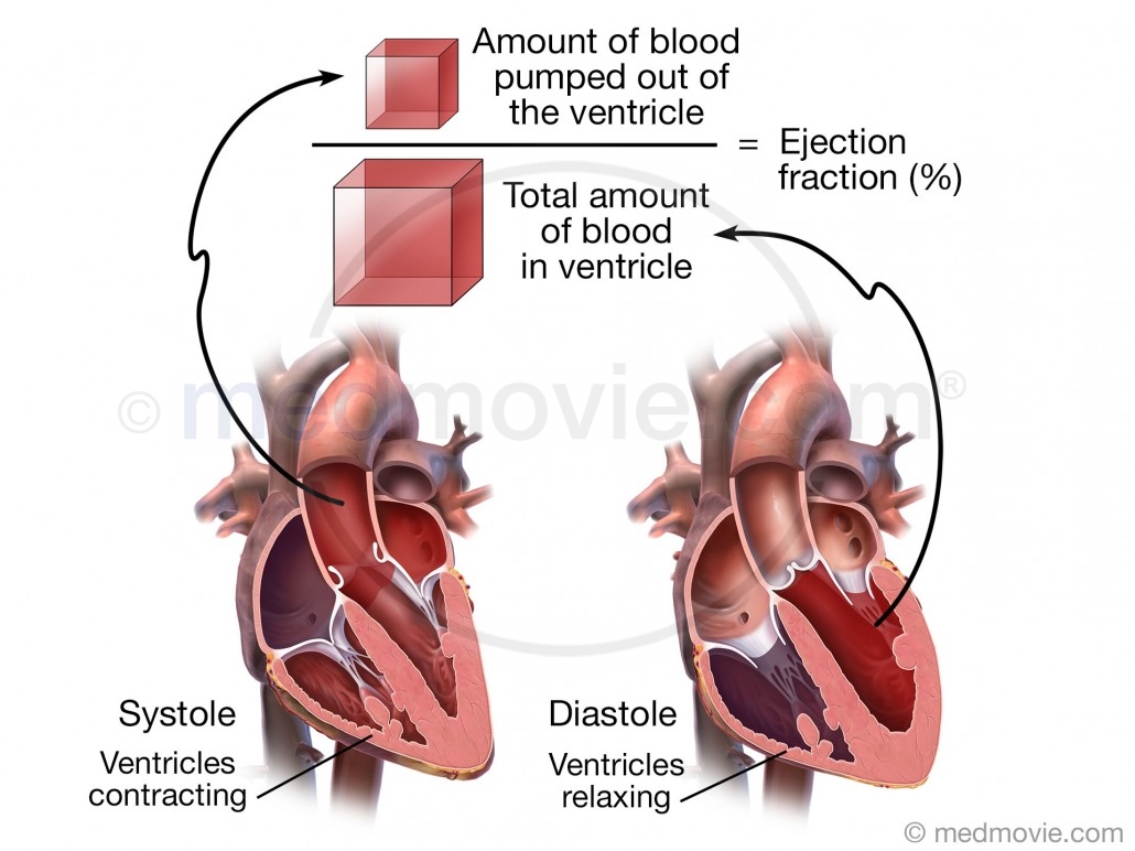 stages-of-heart-failure-st-anthony-s-hospice