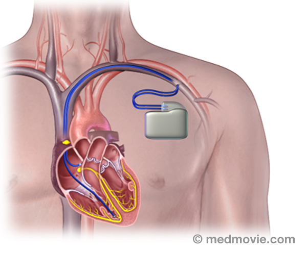 pacemakers-dual-chamber