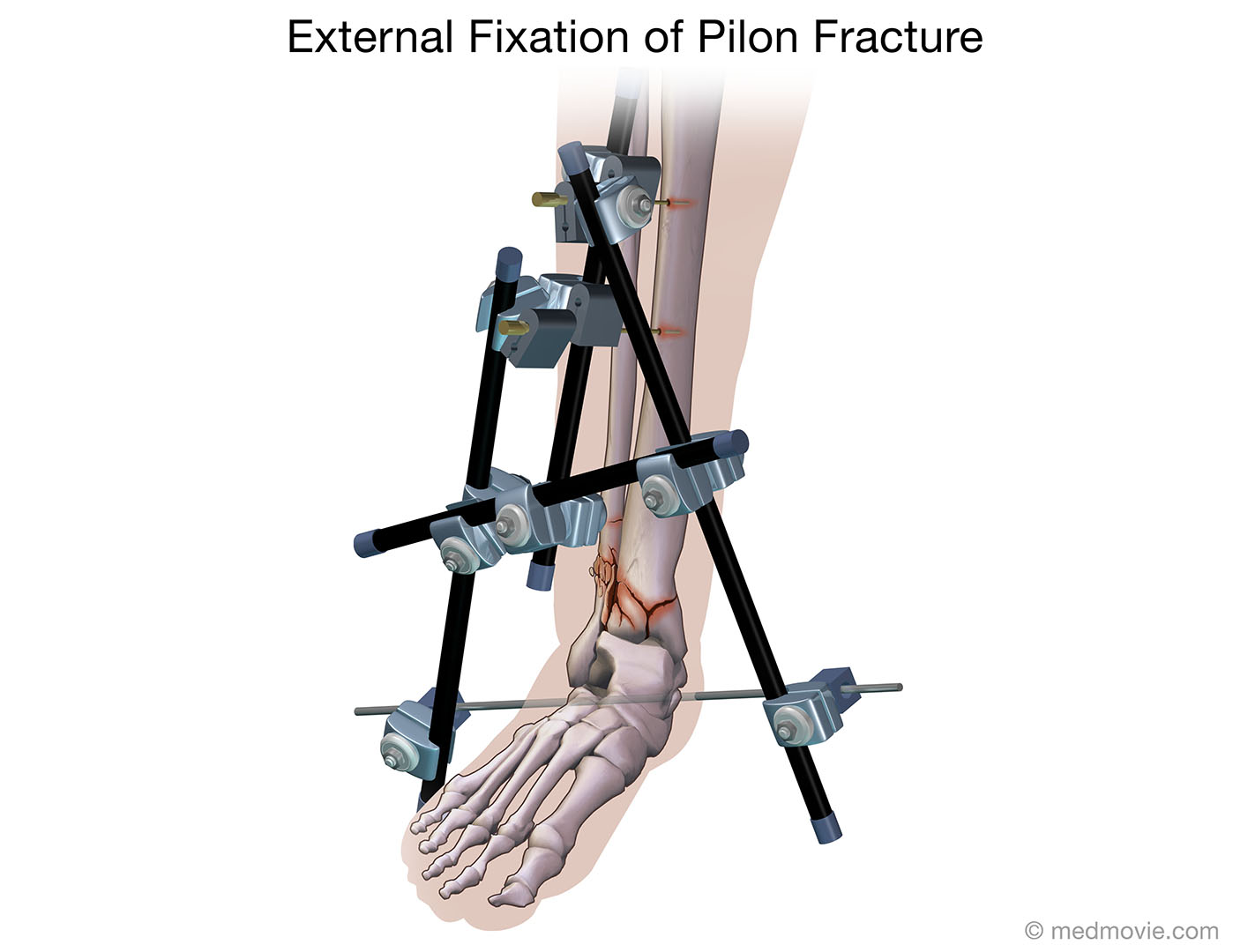 pilon fracture recovery blog