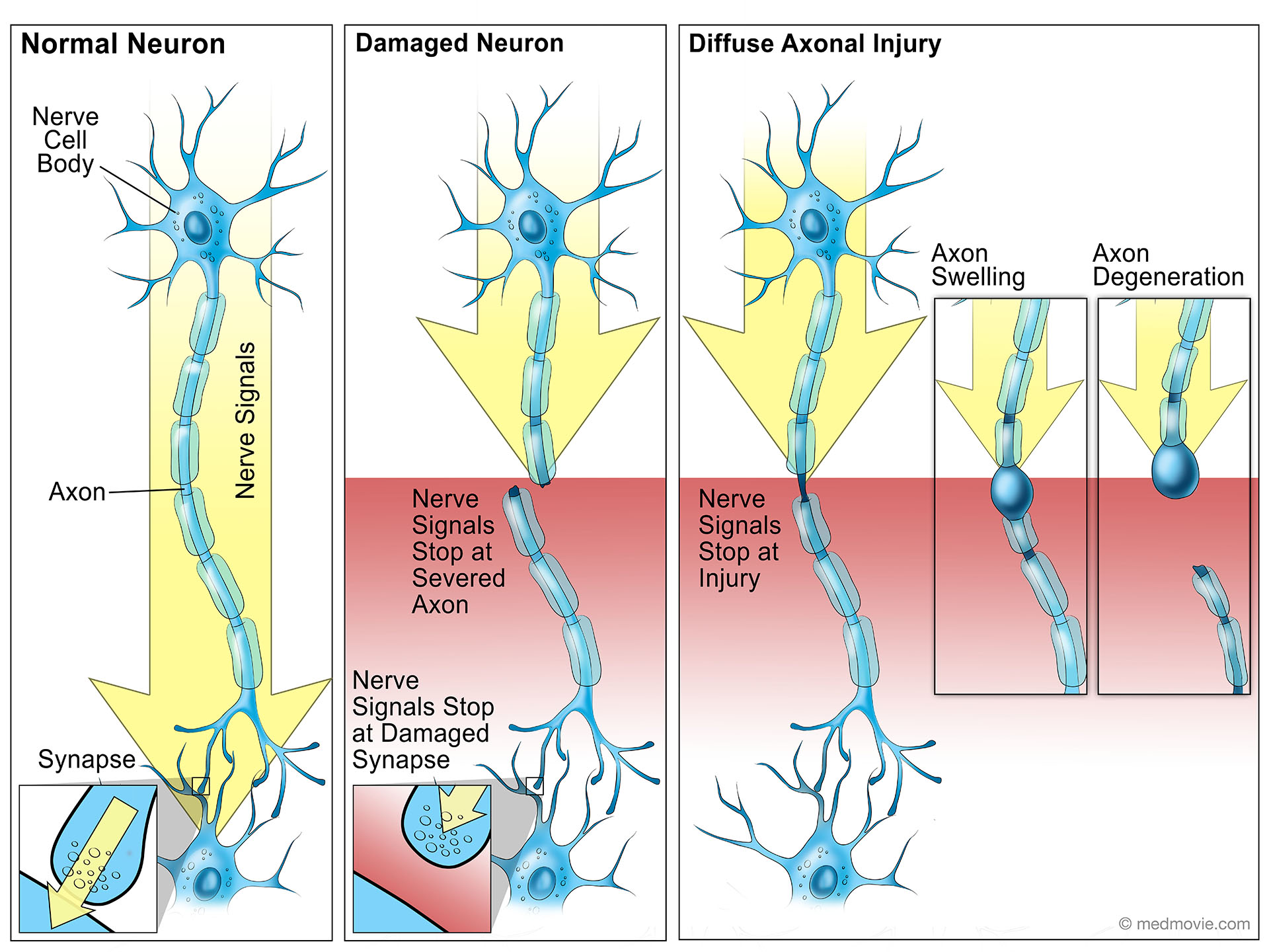 medmovie-damaged-neurons-and-diffuse-axonal-injury