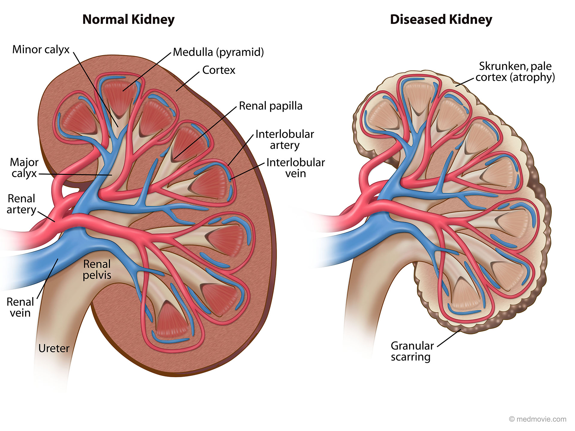 medmovie-normal-kidney-versus-kidney-with-renal-failure