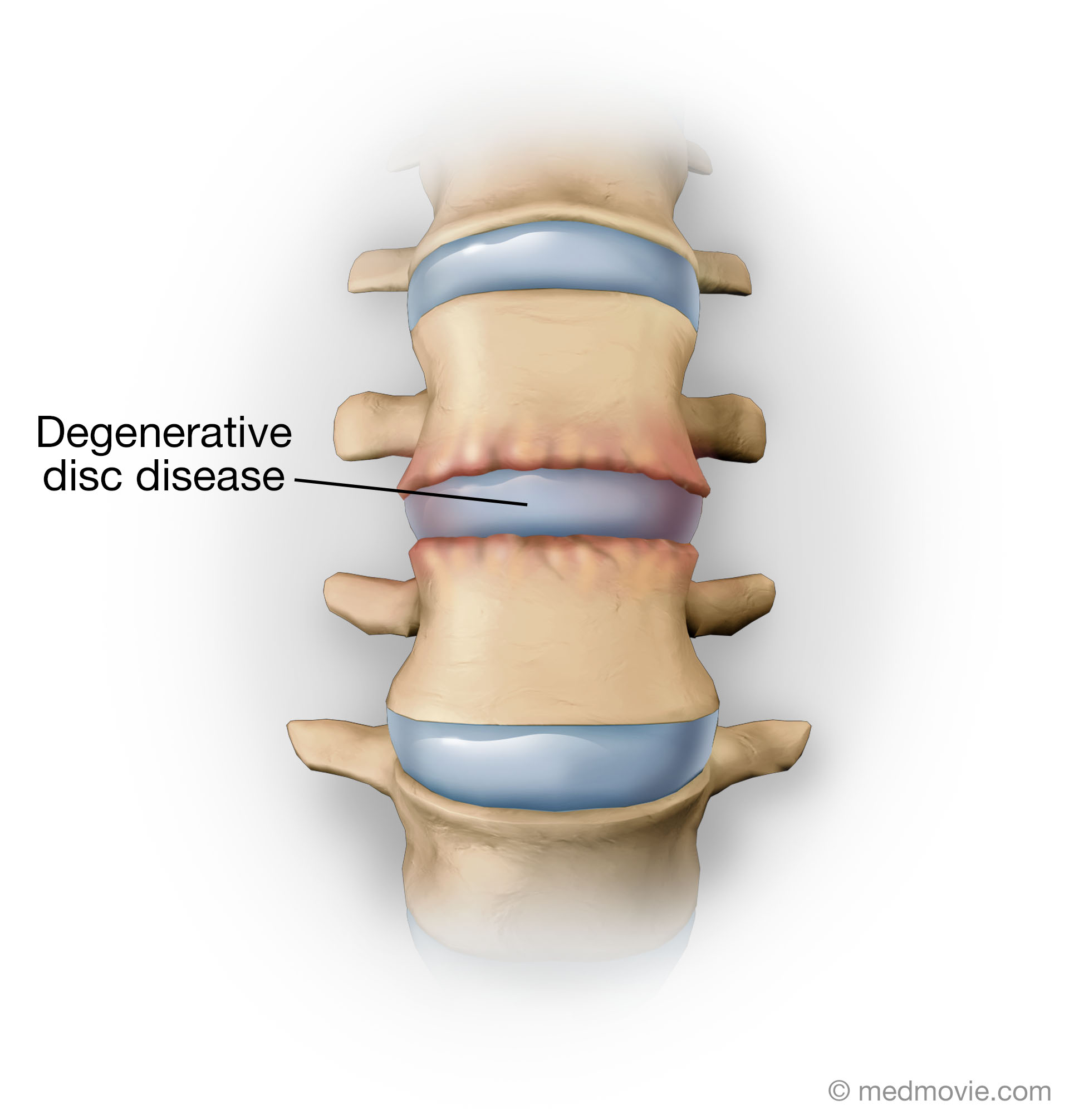 Degenerated Intervertebral Disc Medmovie