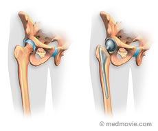 Intervertebral Discs