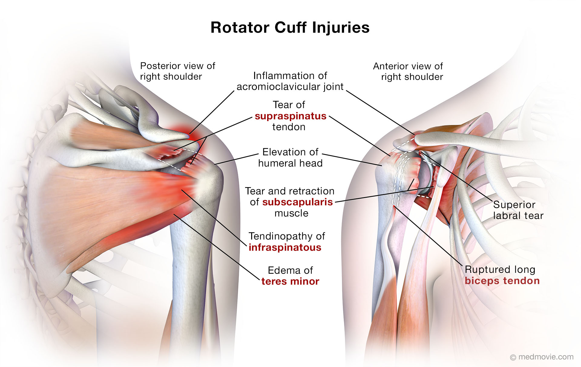 Rotator Cuff Injury