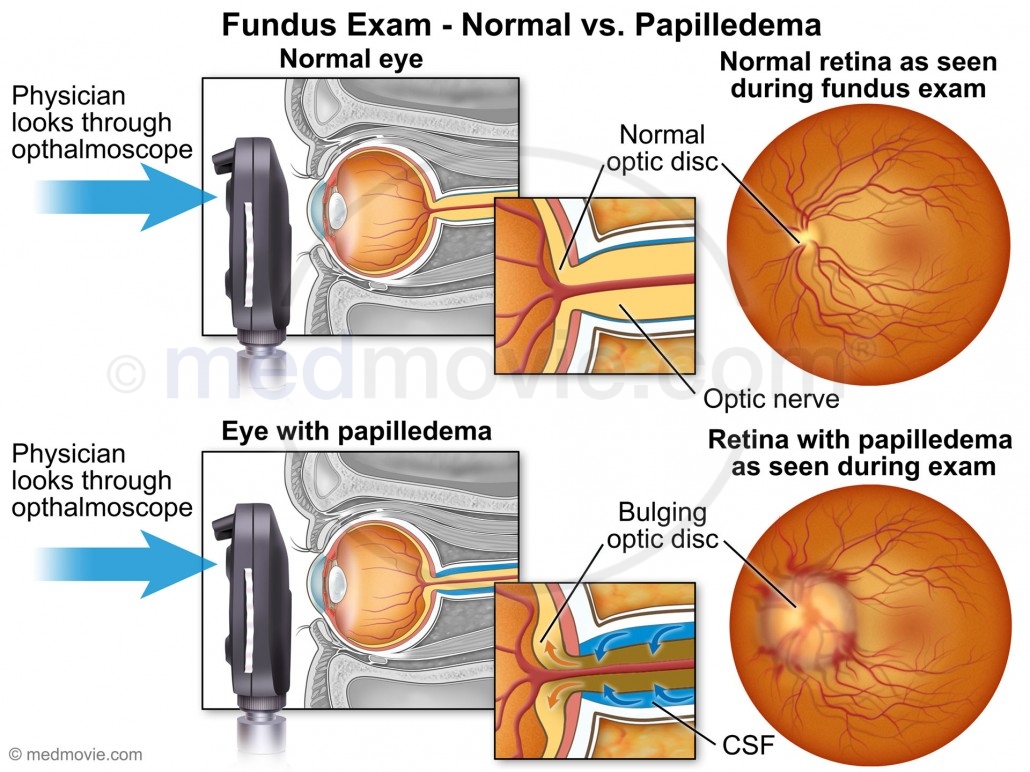 Fundus Exam - Normal vs. Papilledema