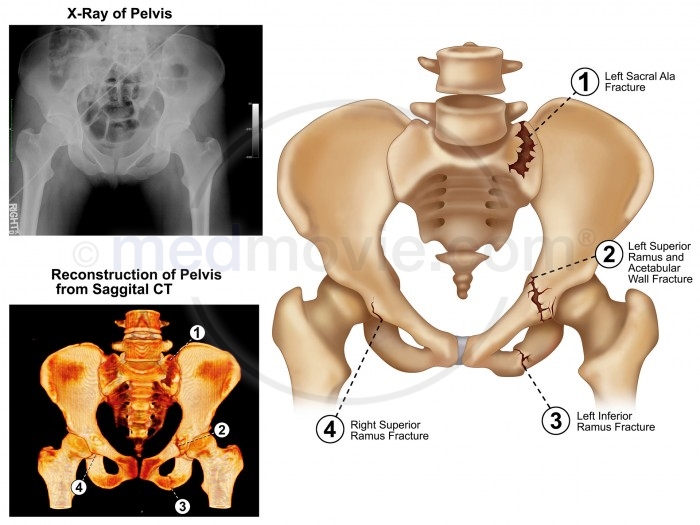 Pelvic Fractures