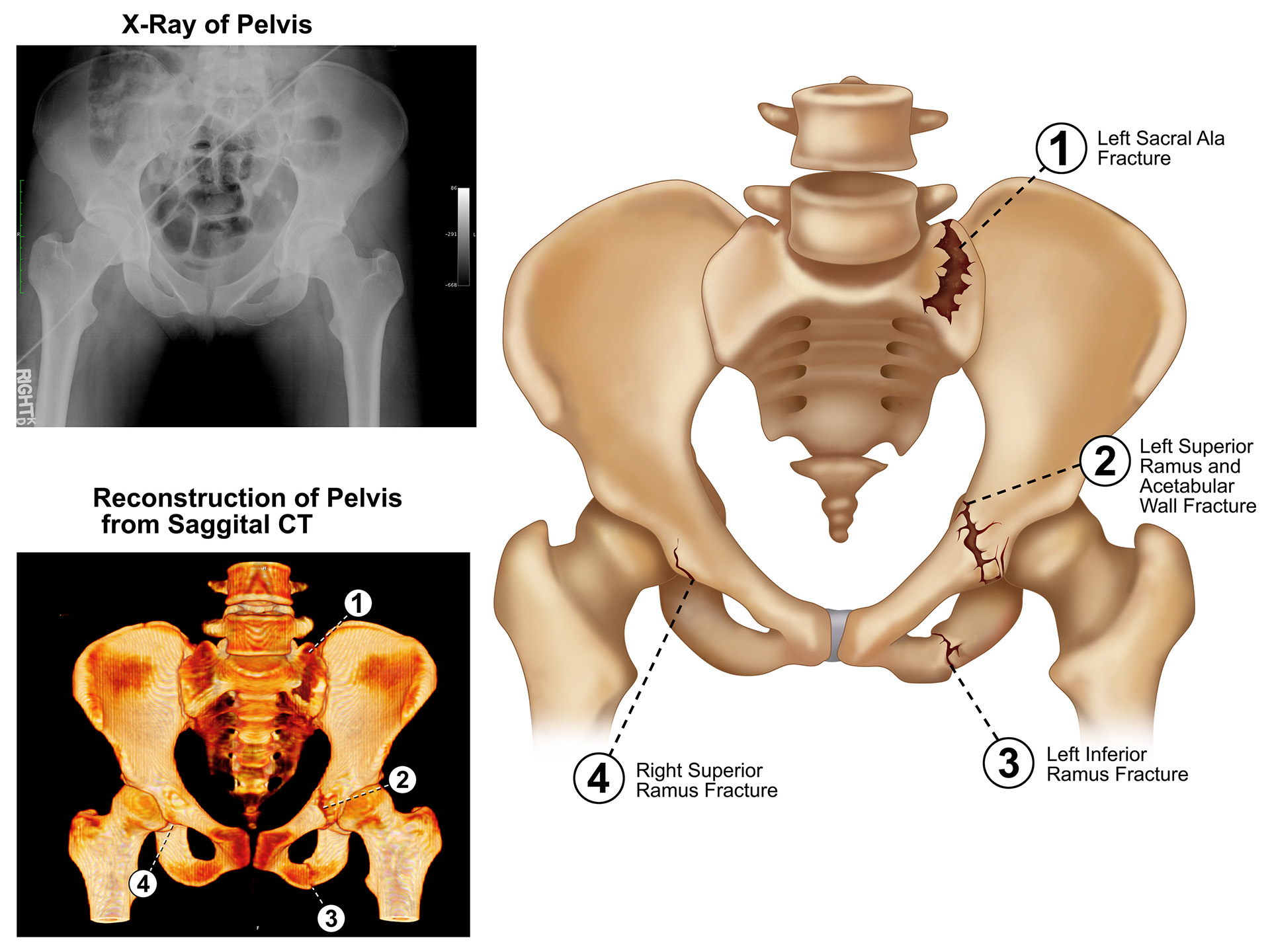 Pelvic Fractures Medmovie Com