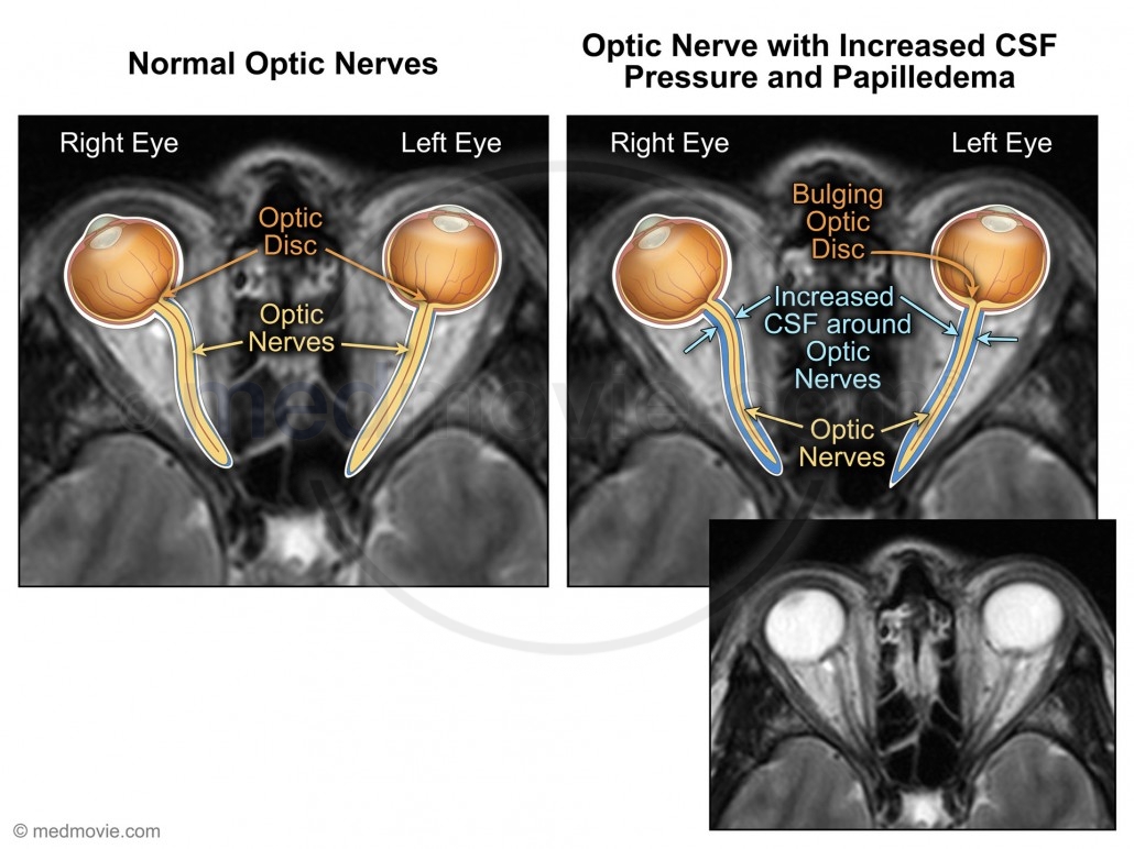 MRI Findings of Optive Nerve and Increased CSF Pressure