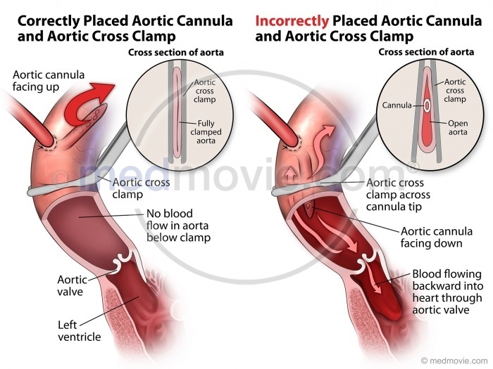 aortic cross clamp