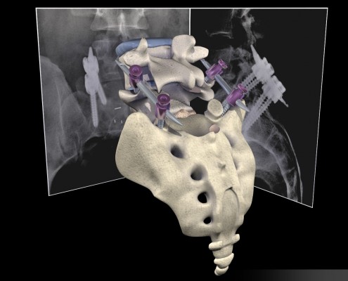 Vertebral Fixation