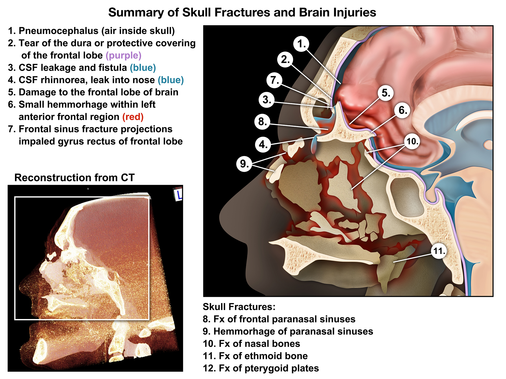 types of skull fracture