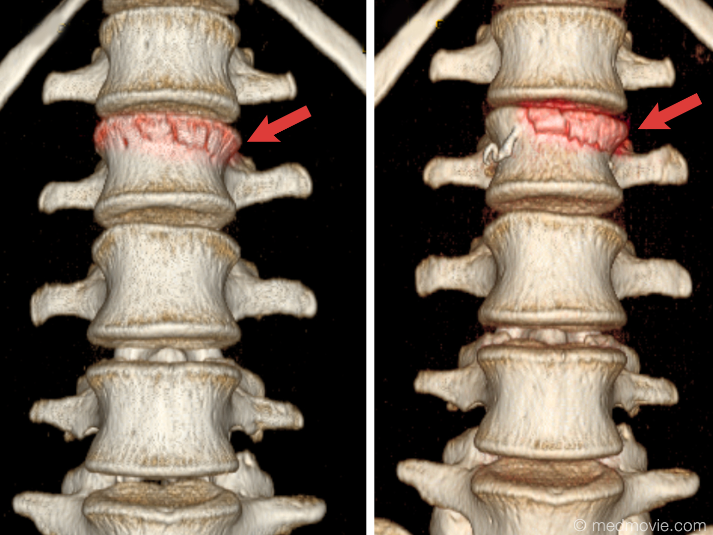 l2 vertebrae