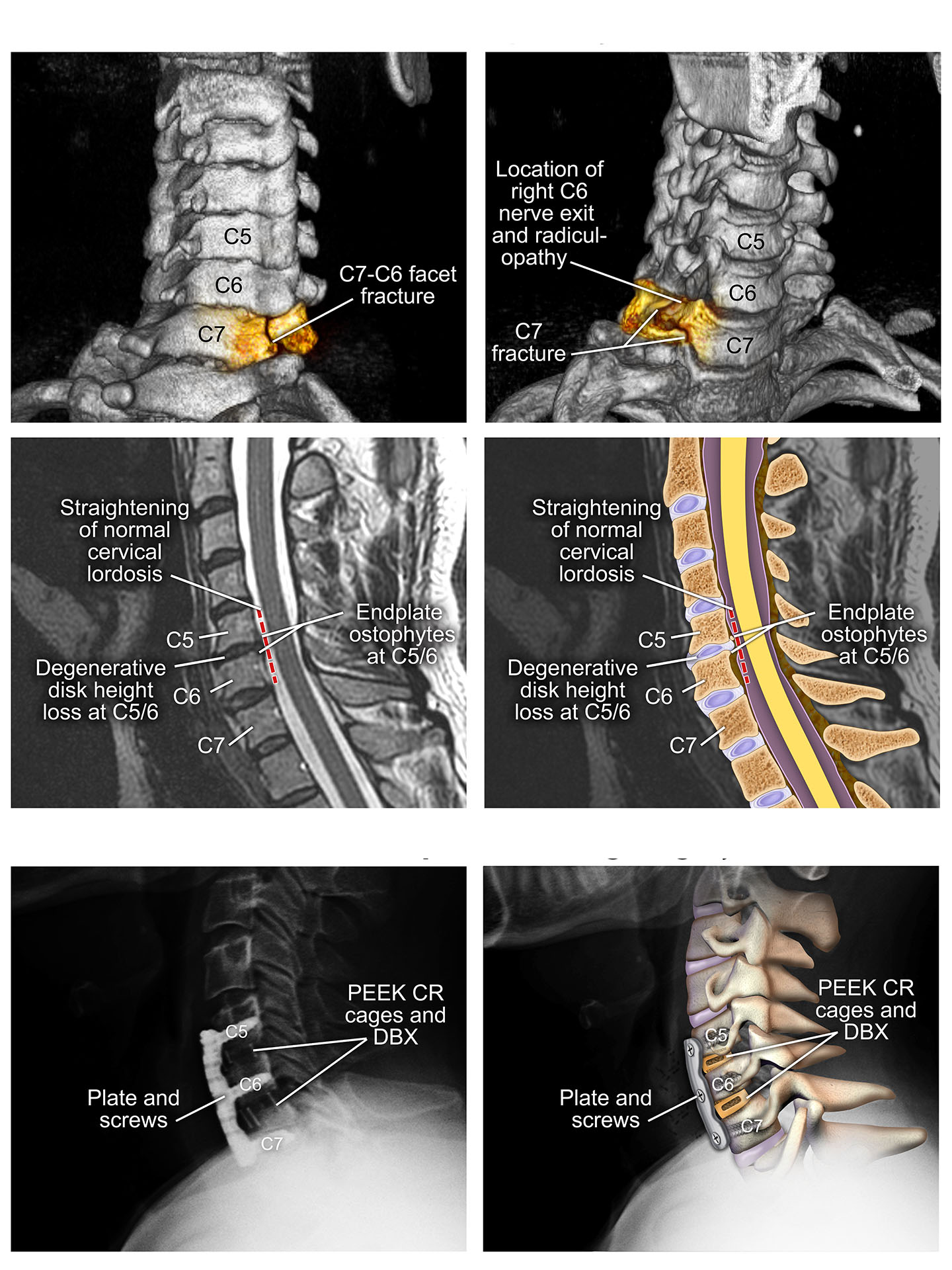 Cervical Fracture Human Spine Vertebrae Damage Outline Diagram Labeled ...