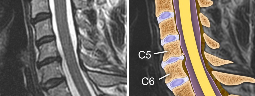 Cervical Spine Fractures and Surgical Fixation – Medmovie.com