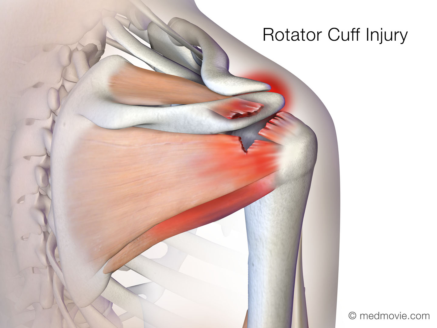 Rotator Cuff Tendonitis