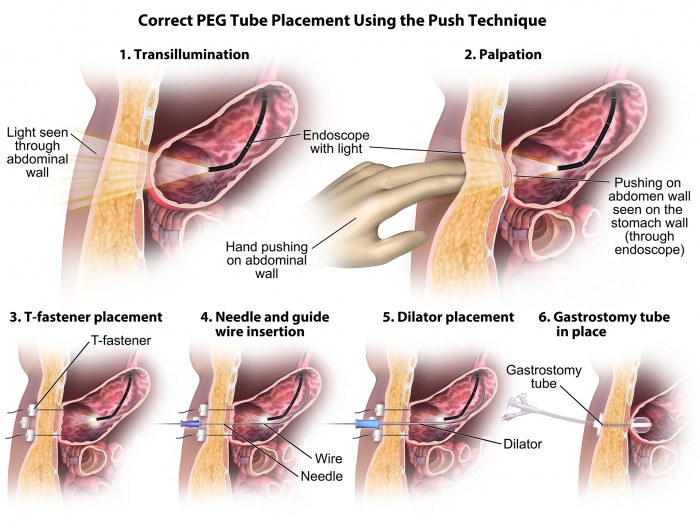 Peg tube insertion