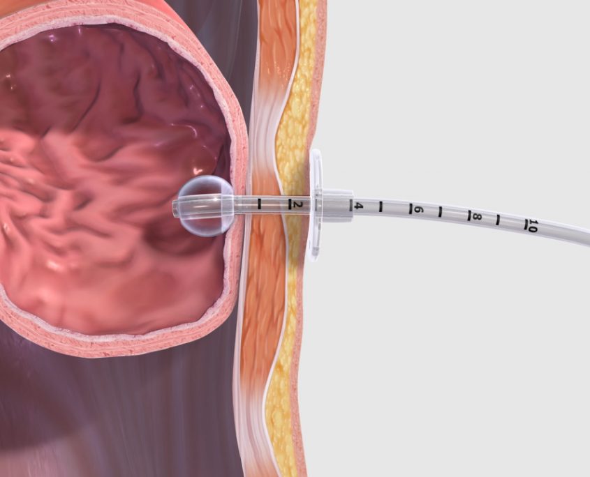 Medical Device Animation – Medmovie.com – Medmovie.com