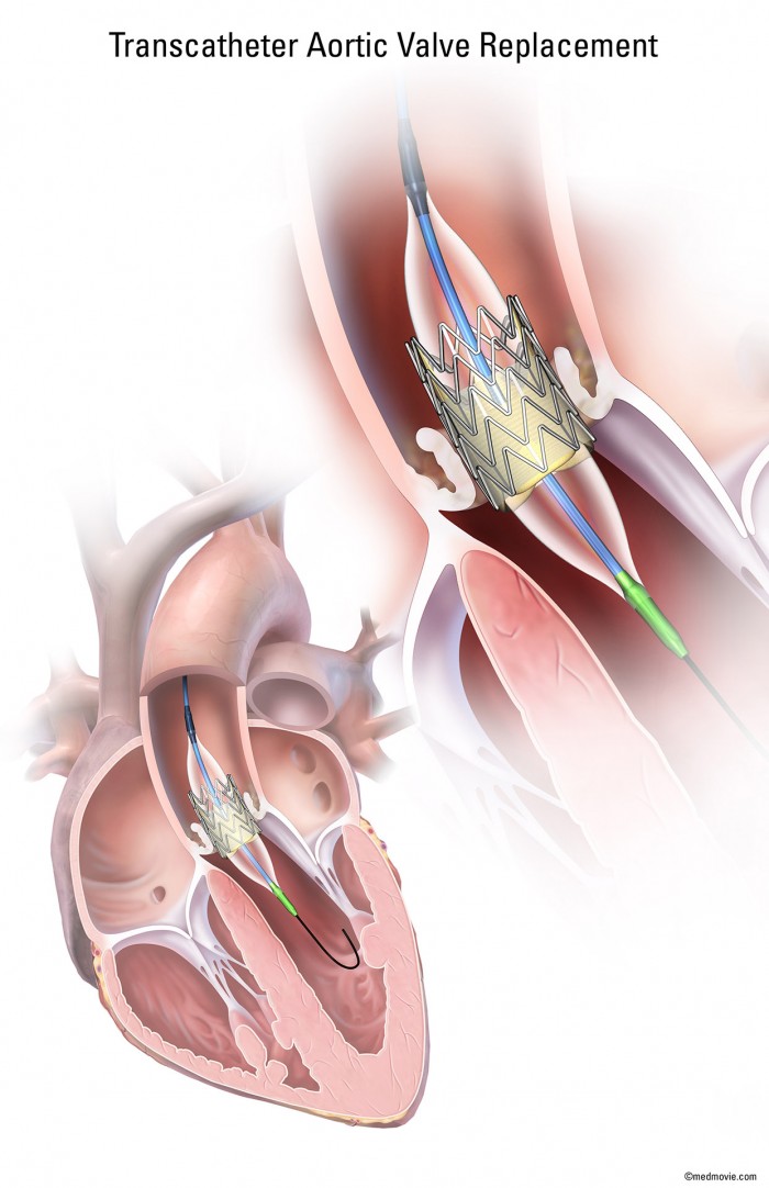 2999_01_TAVR_11x17