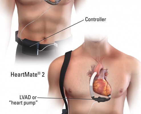 2999_04_LVAD_v2