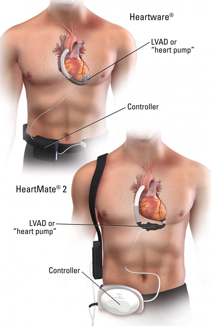 2999_04_LVAD_v2
