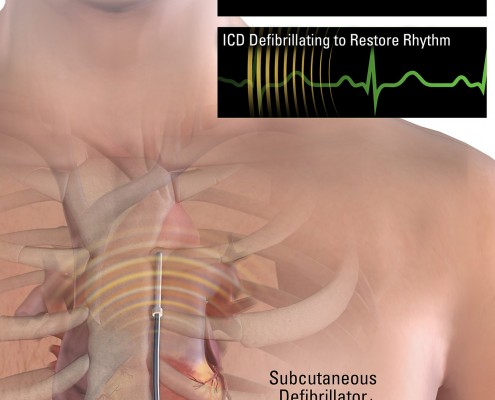 2999_07_SubcutaneousDefib_11x17