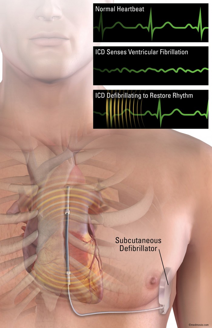 2999_07_SubcutaneousDefib_11x17