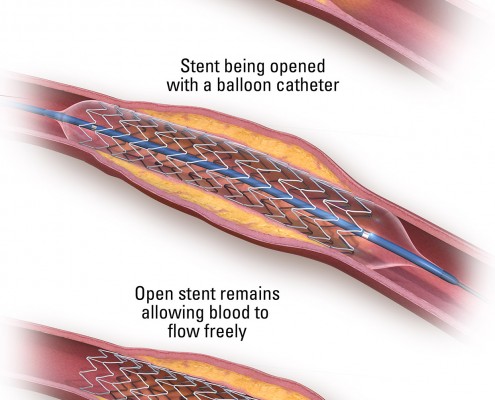 2999_08_Stenting_11x17