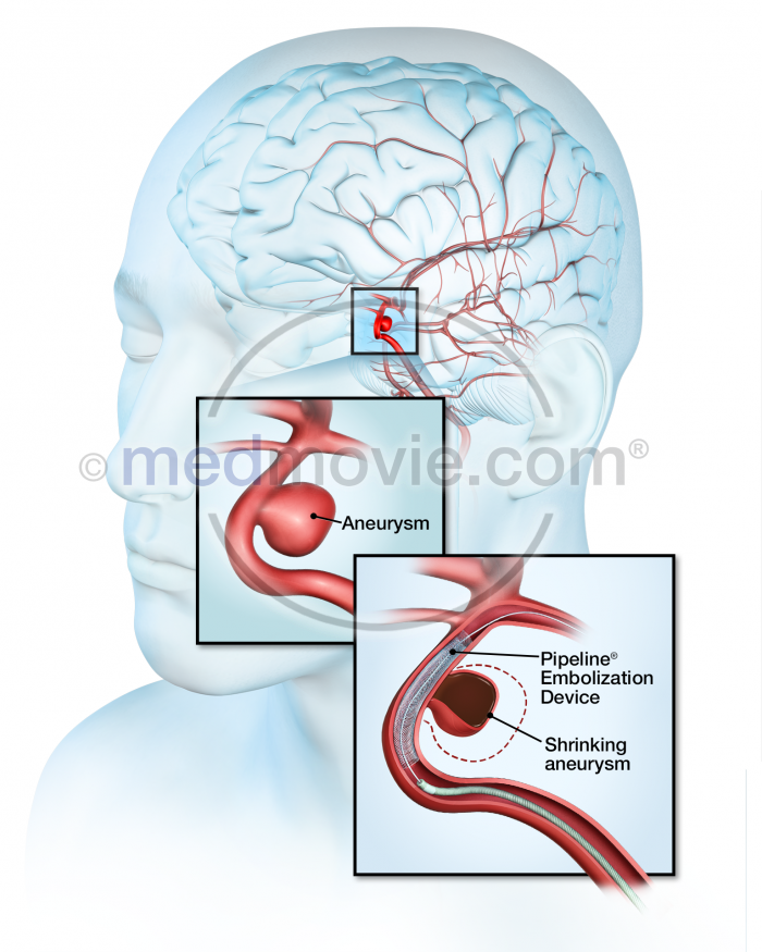 Aneurysm Medmovie Com