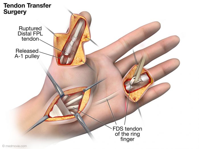 tendon-rupture-following-trigger-finger-release-medmovie