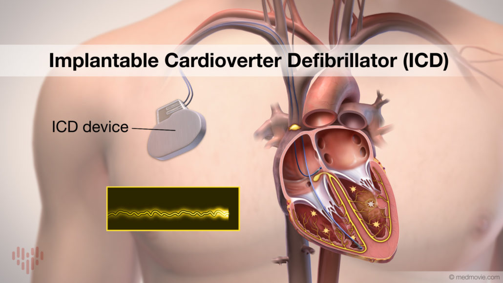 Atrial Fibrillation Ablation