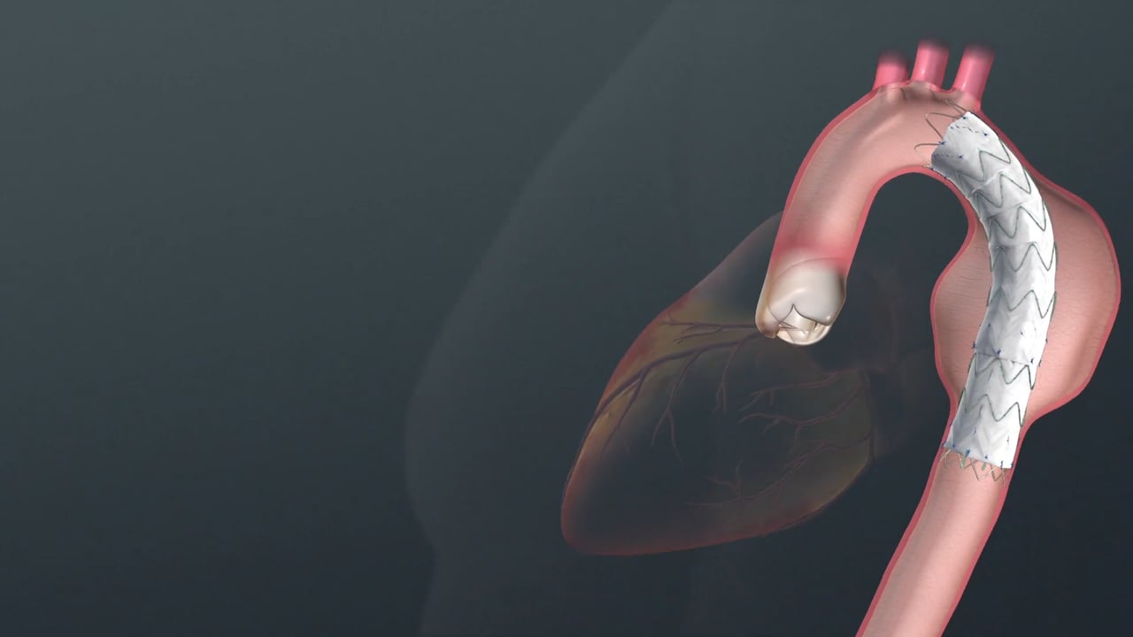 Cook Alpha Abdominal Aortic Aneurysm – Instructional – Medmovie.com