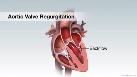 Aortic Valve Regurgitation