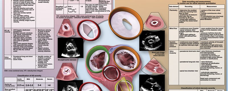 Medmovie.com | ASE Poster 7: Echocardiographic Assessment of Valve Stenosis