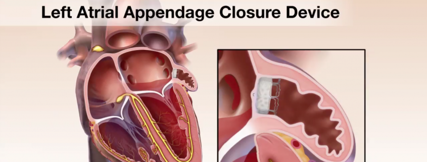 left atrial appendage closure icd 10 pcs