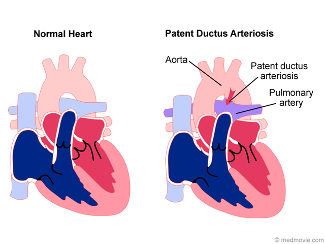 Patent Ductus Arteriosus Animation
