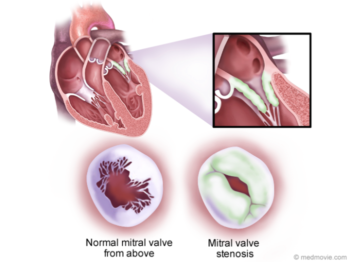 Blood Clot