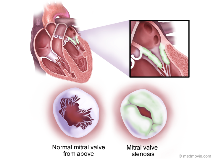 mitral valve stenosis
