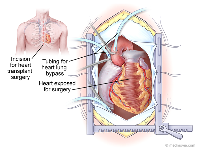 Diagram Of Heart Transplantation Choice Image - How To 