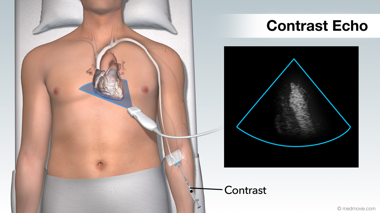 transesophageal-echocardiogram