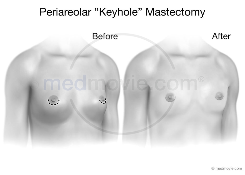 Periareolar or Keyhole Mastectomy