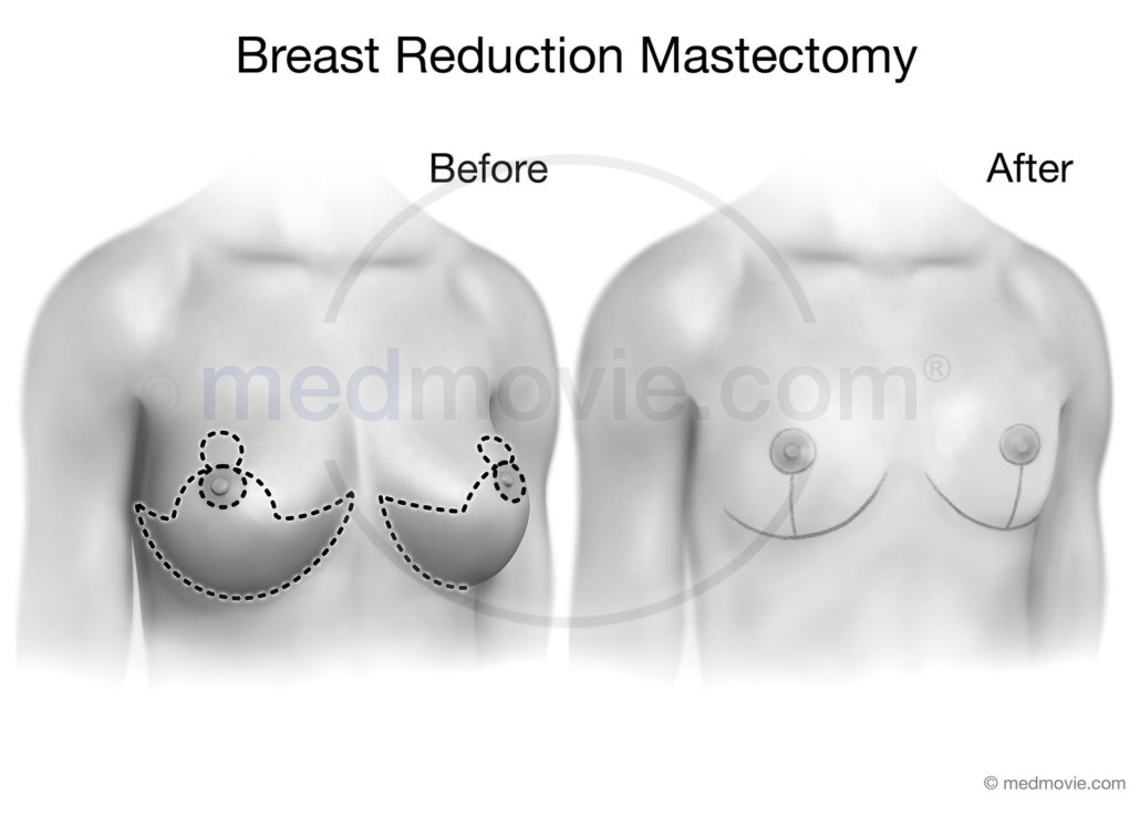 Breast Reduction Mastectomy