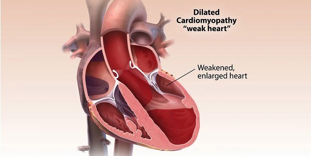 Cardiomyopathy – Medmovie.com